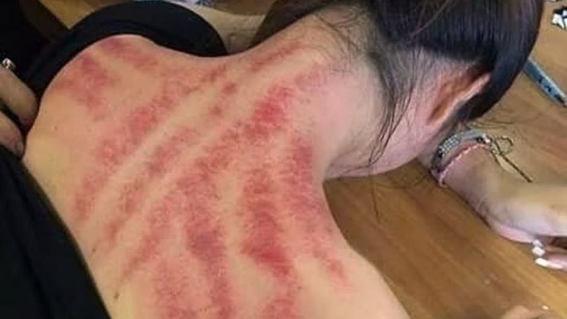 What Exactly Is Kerokan? The Indonesian "Gua Sha" You Didn't Know You Needed